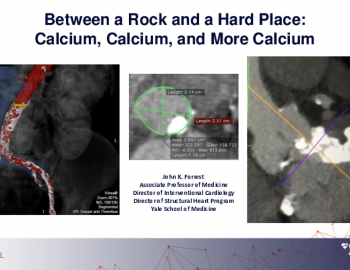 Between a Rock and a Hard Place: Calcium, Calcium, and More Calcium