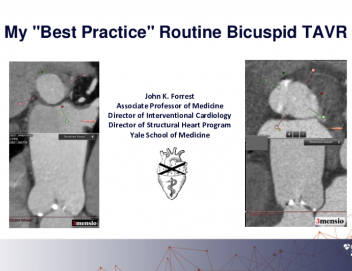 My "Best Practice’" Routine Bicuspid TAVR