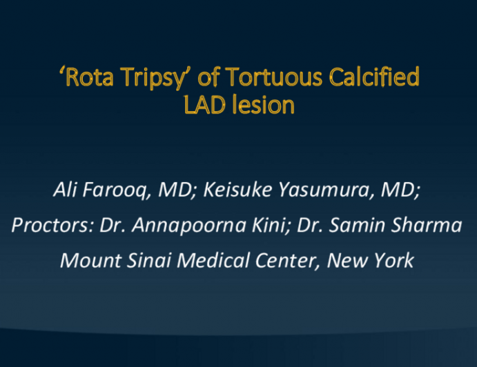 TCT 590: ‘Rota Tripsy’ of Tortuous Calcified LAD/D1 Bifurcation