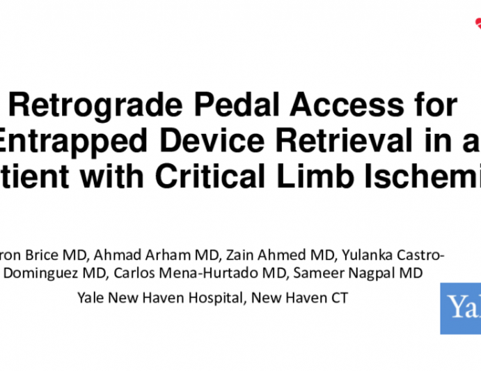 TCT 678: Retrograde Pedal Access for Entrapped Device Retrieval in a Patient With Critical Limb Ischemia