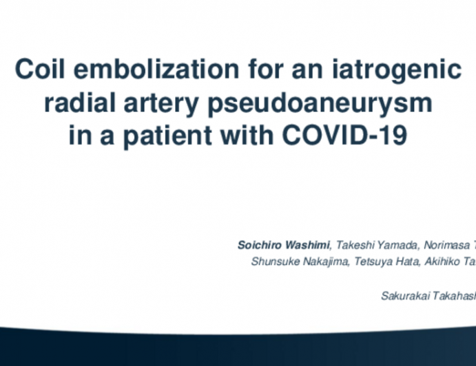 TCT 688: Coil embolization for an iatrogenic radial artery pseudoaneurysm in a patient with COVID-19