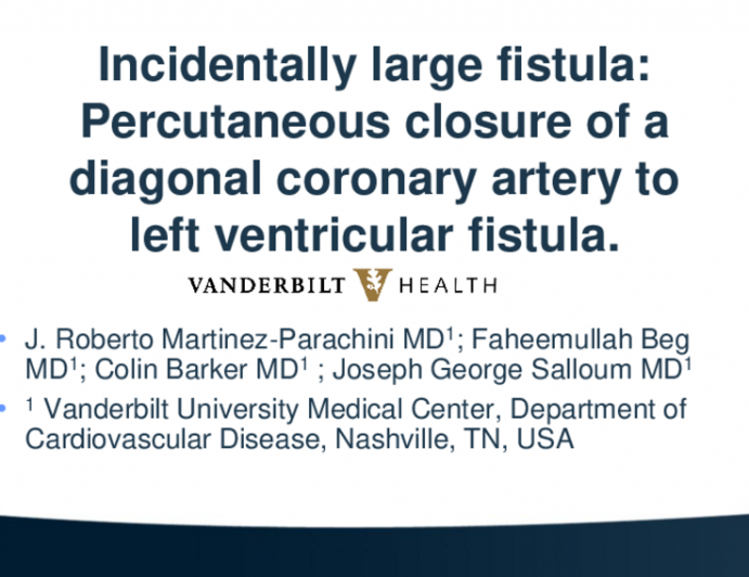 TCT 609: Percutaneous Closure of a Large Diagonal Coronary Artery to Left Ventricular Fistula