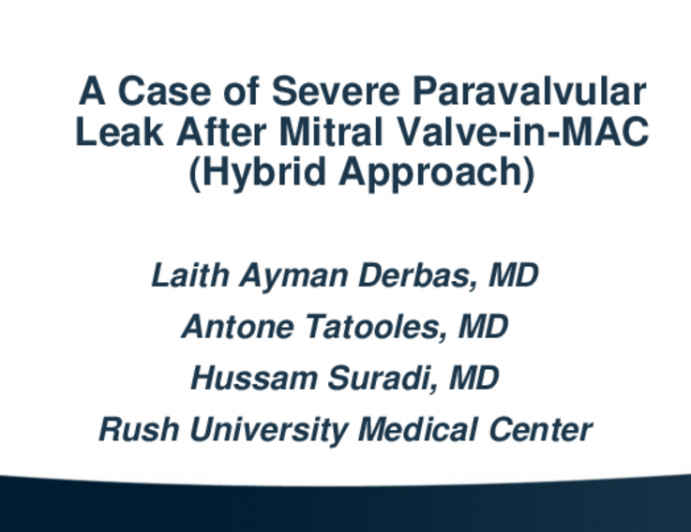 TCT 580: A Case Of Severe Paravalvular Leak After Mitral Valve-In-MAC Using Edwards Sapien 26mm Valve And A Hybrid Approach