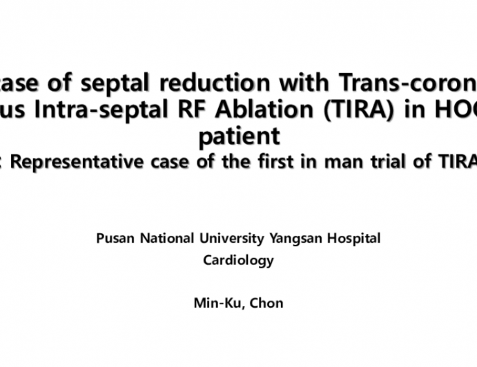 TCT 713: A Case Of Septal Reduction With Tru-Septal RF Ablation Via Coronary Sinus (TIRA) In HOCM Patient: Representative Case of The First in Man Trial Of TIRA