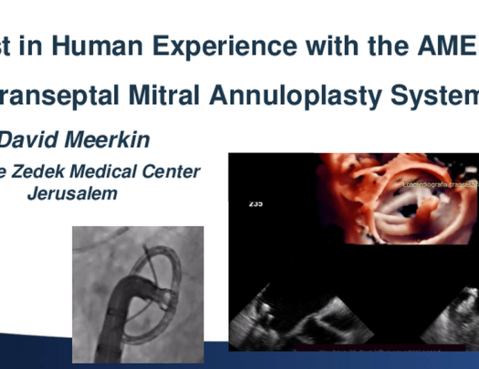 First in Human Clinical Experience With AMEND Annuloplasty for Mitral Repair