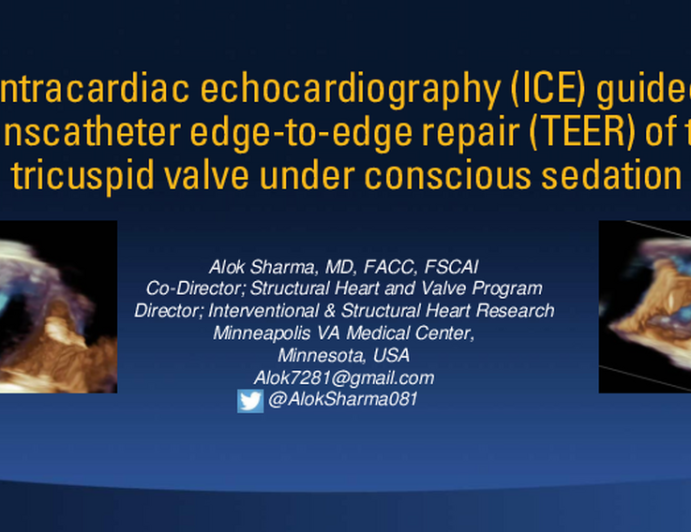 Intracardiac Echocardiography (ICE) Guided Transcatheter Edge-to-Edge Repair (TEER) of the Tricuspid Valve Under Conscious Sedation