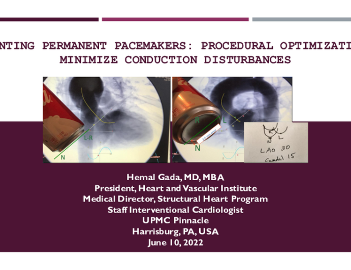 Preventing Permanent Pacemakers: Procedural Optimization to Minimize Conduction Disturbances
