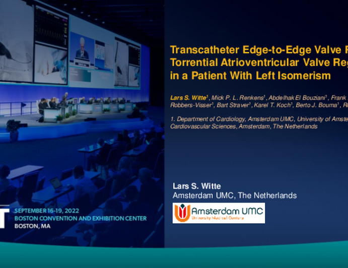 TCT 650: Transcatheter Edge-to-Edge Valve Repair for Torrential Atrioventricular Valve Regurgitation in a Patient With Left Isomerism