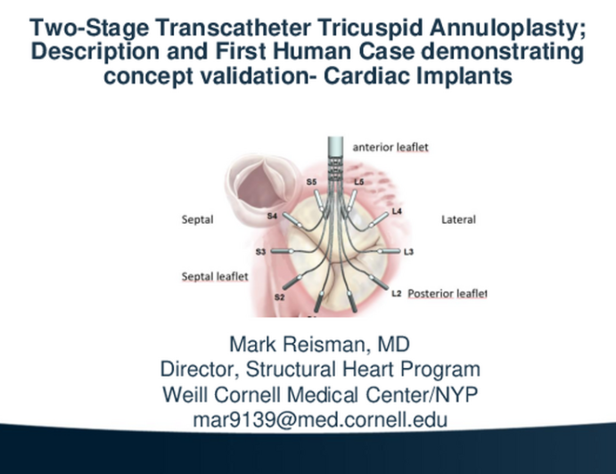 Two-Stage Transcatheter Tricuspid Annuloplasty: Technology Description and First Human Case Demonstrating Concept Validation (Cardiac Implants)