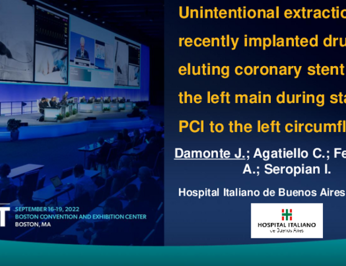 TCT 785: Unintentional Extraction of a Recently Implanted Drug Eluting Coronary Stent From the Left Main During Staged PCI to the Left Circumflex
