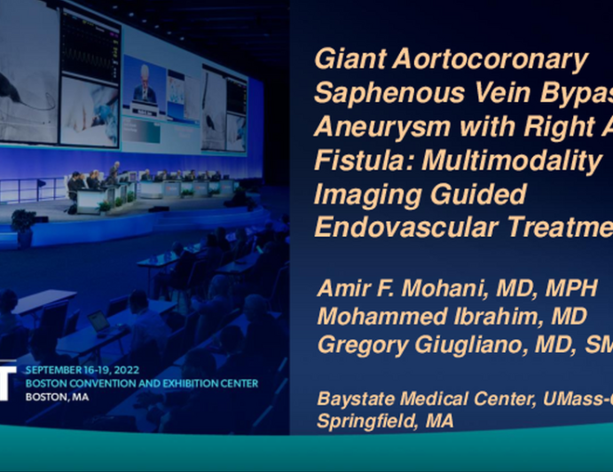 TCT 629: Giant Aortocoronary Saphenous Vein Bypass Graft Aneurysm with Right Atrial Fistula: Multimodality Imaging Guided Endovascular Treatment