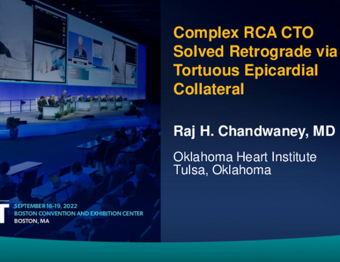 TCT 699: Complex RCA CTO Solved Retrograde via a Tortuous Epicardial Collateral
