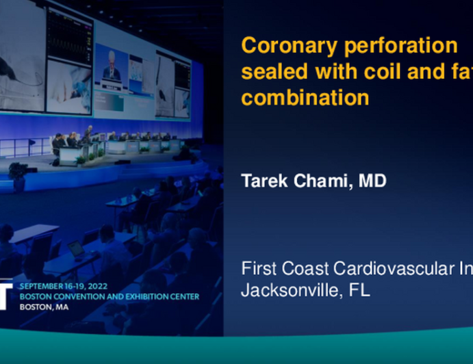 TCT 651: Coronary perforation sealed with coil and fat combination