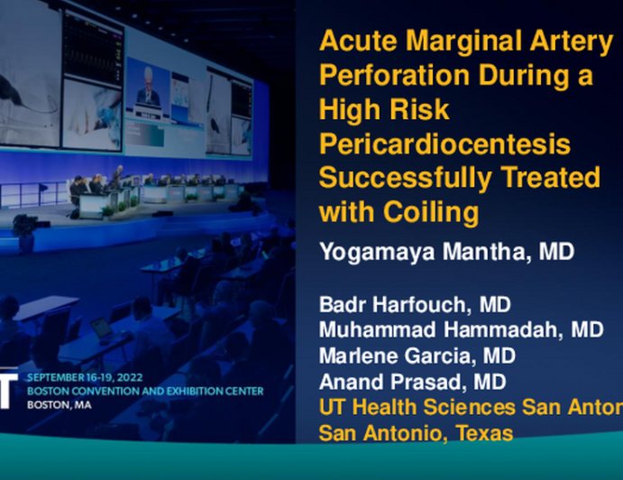 TCT 622:  Acute Marginal Artery Perforation During a High Risk Pericardiocentesis Successfully Treated with Coiling