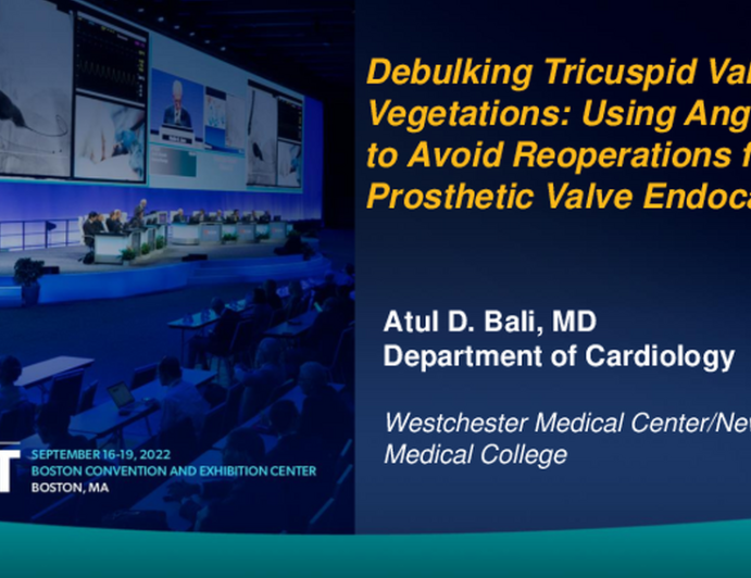 TCT 694: Debulking Tricuspid Valve Vegetations: Using AngioVac to Avoid Reoperations for Prosthetic Valve Endocarditis