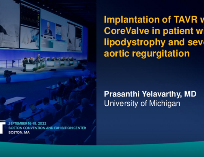 TCT 674: Implantation of TAVR with Corevalve in patient with lipodystrophy and severe aortic regurgitation. 