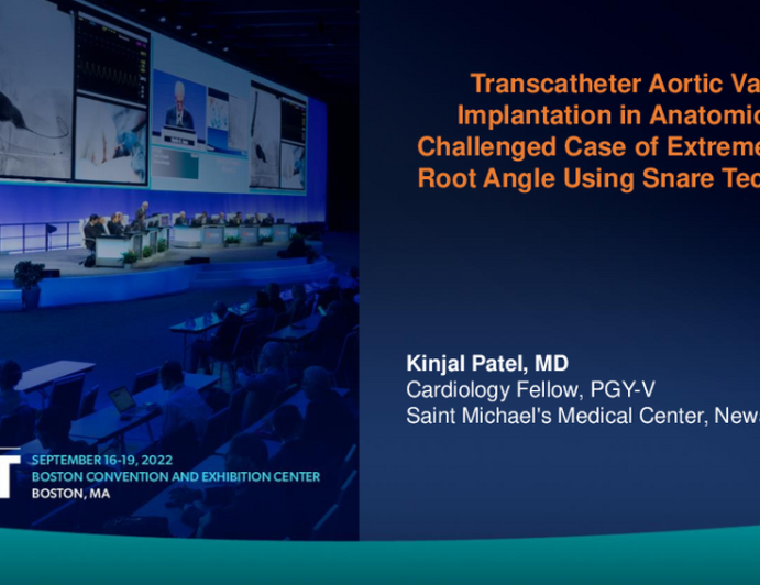TCT 827: Transcatheter Aortic Valve Implantation in an Anatomically Challenged Case of Extreme Aortic Root Angle Using Snare Technique   