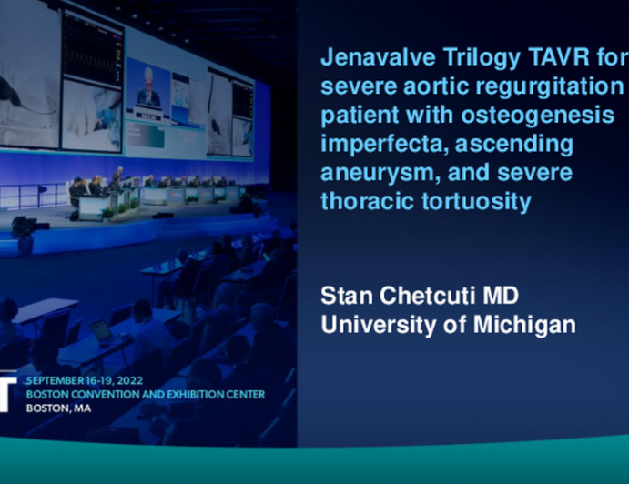 TCT 678: Jenavalve Trilogy TAVR for severe aortic regurgitation in patient with osteogenesis imperfecta, ascending aneurysm, and severe thoracic tortuosity
