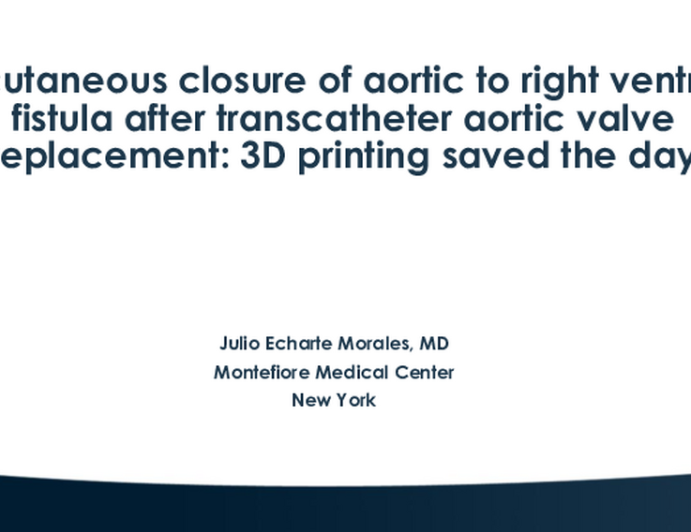 Percutaneous Closure of Aortic to Right Ventricle Fistula After Transcatheter Aortic Valve Replacement: 3D Printing Saved the Day