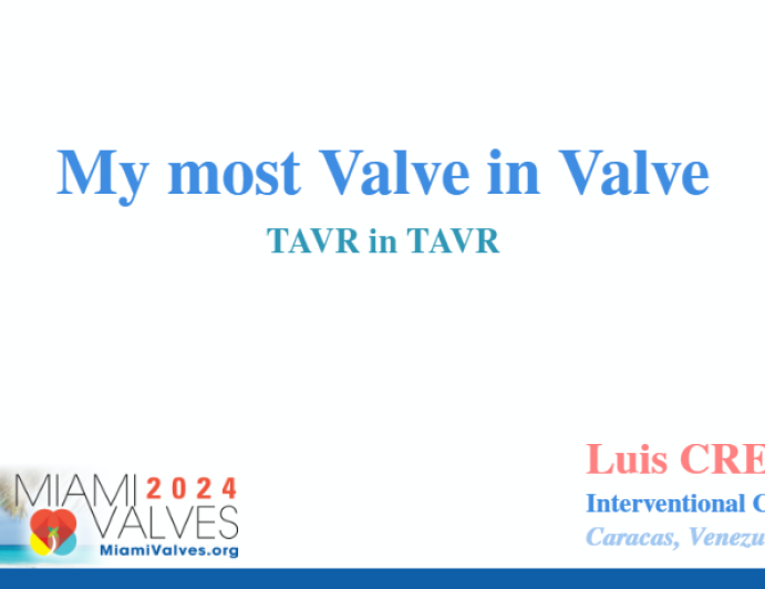 My most Valve in Valve TAVR in TAVR