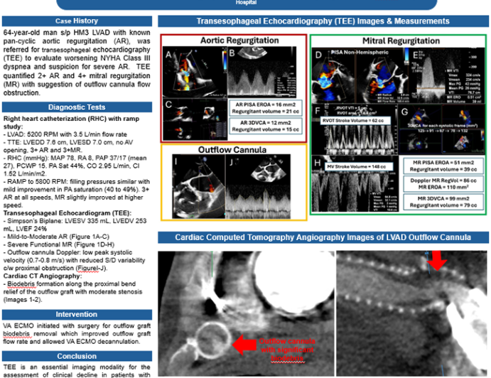 Echocardiographic Assessment of Progressive Dyspnea in an LVAD Patient