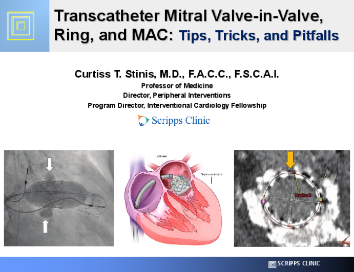 Transcatheter Mitral Valve-in-Valve, Ring, and MAC: Tips, Tricks, and Pitfalls