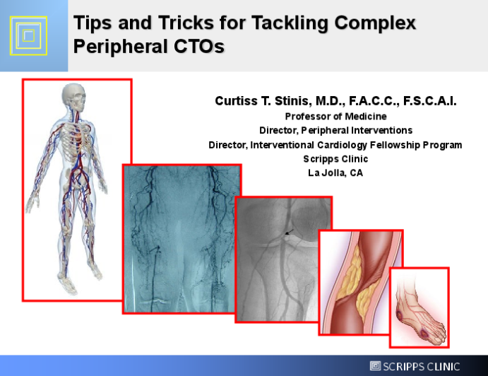 Tips and Tricks for Tackling Complex Peripheral CTOs