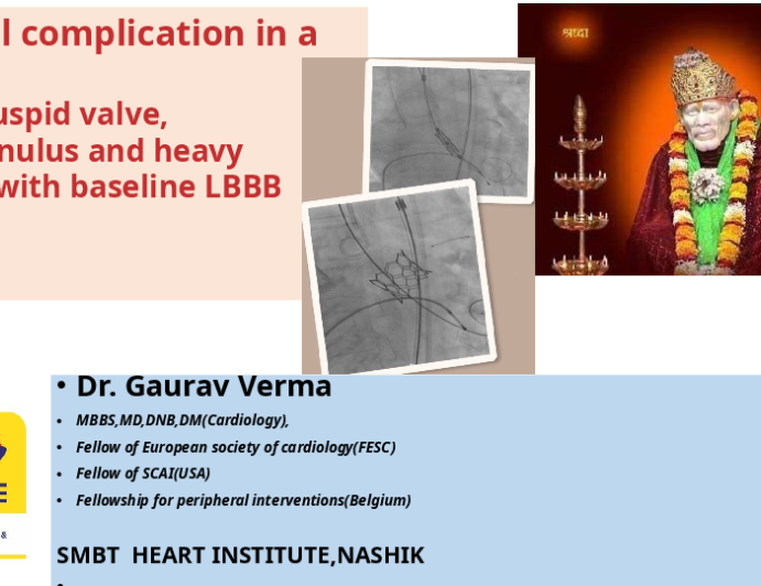 Unusual Complication In A TAVR With Bicuspid Valve, Small Annulus, And Heavy Calcium With Baseline LBBB