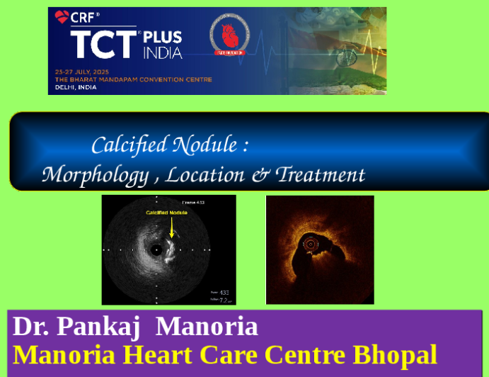 Calcified Nodule: Morphology, Location & Treatment