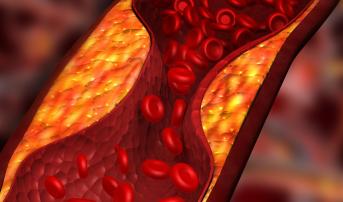 Atherosclerosis Progression May Share Traits With Tumor Growth