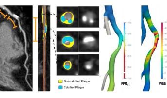 AI Assessment of Plaque, Hemodynamics May ID Lesion-Specific ACS Risk