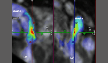 Four-Dimensional Flow CMR Shows Promise in Aortic Stenosis