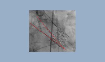 Underexpanded Acurate Valves Come With Higher Stroke Risk, Study Confirms