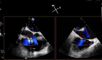 CMS Agrees to Reimburse Tricuspid TEER