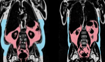 Body Fat Distribution Influences Cardiovascular Age