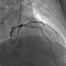 Treatment of LAD Coronary Aneurysm | tctmd.com