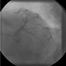 Distal LMCA Bifurcation Stenosis