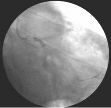 Distal LMCA Bifurcation Stenosis