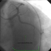 STEMI Patient with Large Thrombus in LM Treated with Full Dose Intracoronary Thrombolytic Therapy