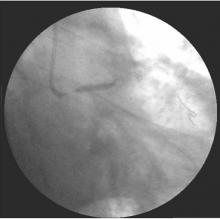 Distal LMCA Bifurcation Stenosis