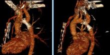 Percutaneous Reconstruction of Interrupted Aortic Arch