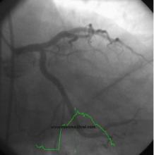 STEMI Patient with Large Thrombus in LM Treated with Full Dose Intracoronary Thrombolytic Therapy