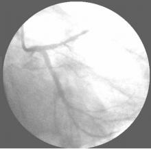 Distal LMCA Bifurcation Stenosis