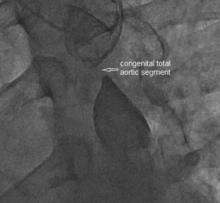 Percutaneous Reconstruction of Interrupted Aortic Arch