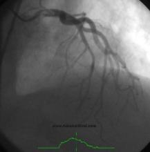 STEMI Patient with Large Thrombus in LM Treated with Full Dose Intracoronary Thrombolytic Therapy