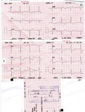 LM Restenosis Presenting with Acute MI and  VF