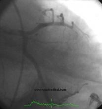 STEMI Patient with Large Thrombus in LM Treated with Full Dose Intracoronary Thrombolytic Therapy