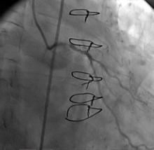 LM Restenosis Presenting with Acute MI and  VF