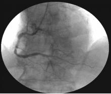 Distal LMCA Bifurcation Stenosis