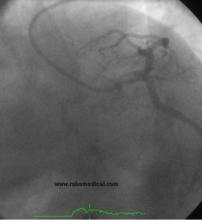 STEMI Patient with Large Thrombus in LM Treated with Full Dose Intracoronary Thrombolytic Therapy